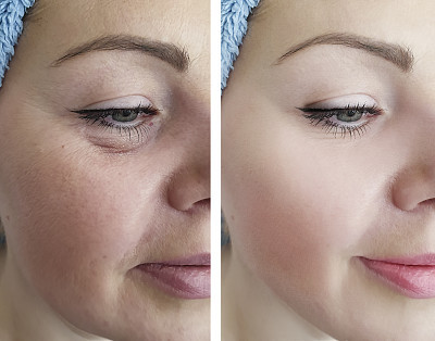 female eye wrinkles before and after correction procedures