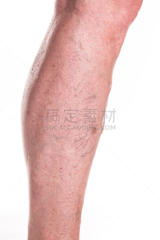 腿,女人,静脉曲张,垂直画幅,蛛状静脉曲张,四肢,衰老过程,仅成年人,技术