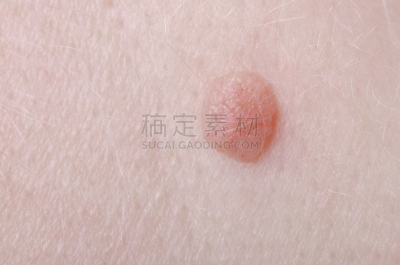 疣,肝斑,水泡,褐色,水平画幅,衰老过程,白人,复杂,特写