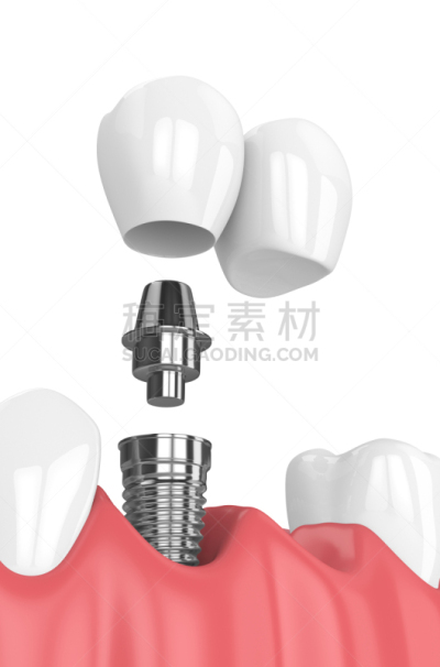 悬臂桥,三维图形,口腔卫生,垂直画幅,合成图像,人造的,牙冠,假牙,牙龈,二叶