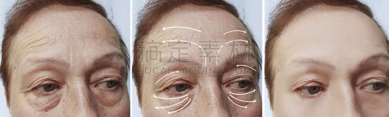 箭头符号,老年女人,皱纹,活力,肿胀的,健康保健,药,塑胶,医疗流程,皮肤病学