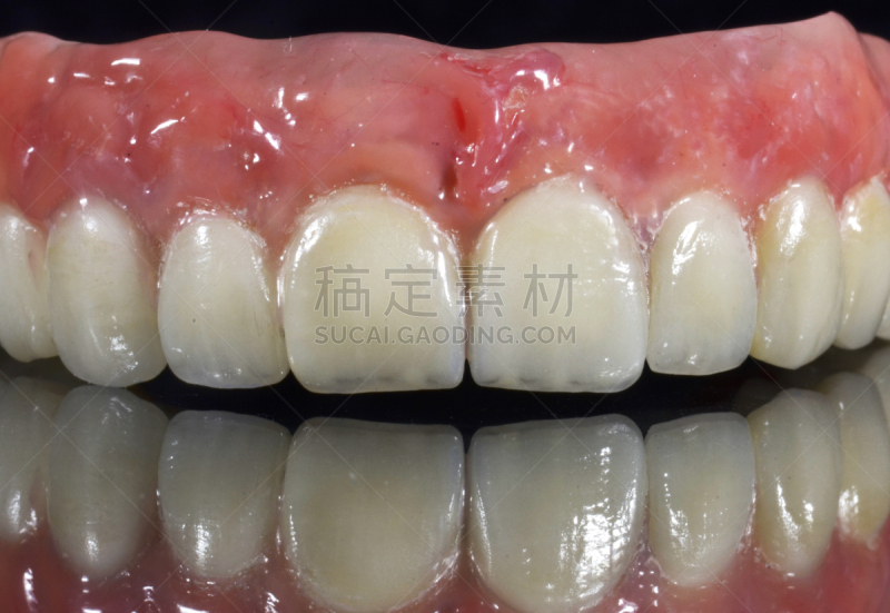口腔卫生,琴码,二叶,变形链球菌,假牙,牙冠,假肢,人造的,新的,水平画幅