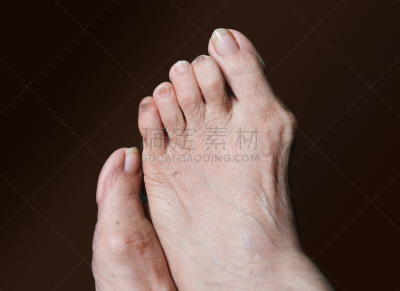 拇趾囊肿胀,褐色背景,脚病医生,肿胀的,乳头,瘀伤,基因突变,中间部分,身体受伤,水平画幅
