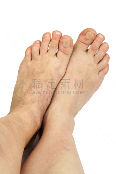 静脉曲张,蛛状静脉曲张,维管束,血凝结,肿胀的,腰部以下,垂直画幅,四肢,腿