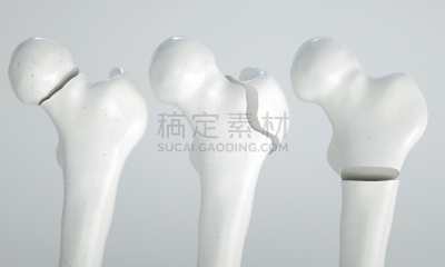 股骨,三维图形,四个物体,粉碎性骨折,骨质疏松症,髂骨,骨关节炎,骨盆,软骨,大腿
