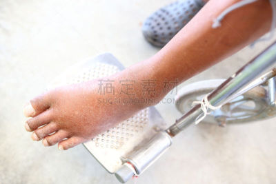 踝,肿胀的,身体受伤,水平画幅,努力,人,健康保健,瘀伤,关节,痛苦