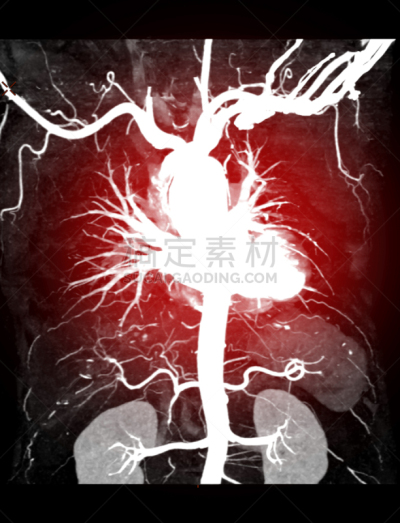 三维图形,反差,图像,动脉瘤,白色,胸主动脉,传媒,心血管系统,血流动