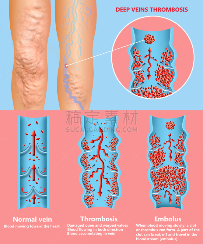 血凝结,血栓症,成年的,仅成年人,老年人,心血管系统,冠状动脉,人类心脏