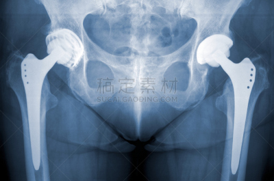 x光,臀,现代,古典式,人工髋关节,骨关节炎,股骨,骨盆,垂直画幅,人造的