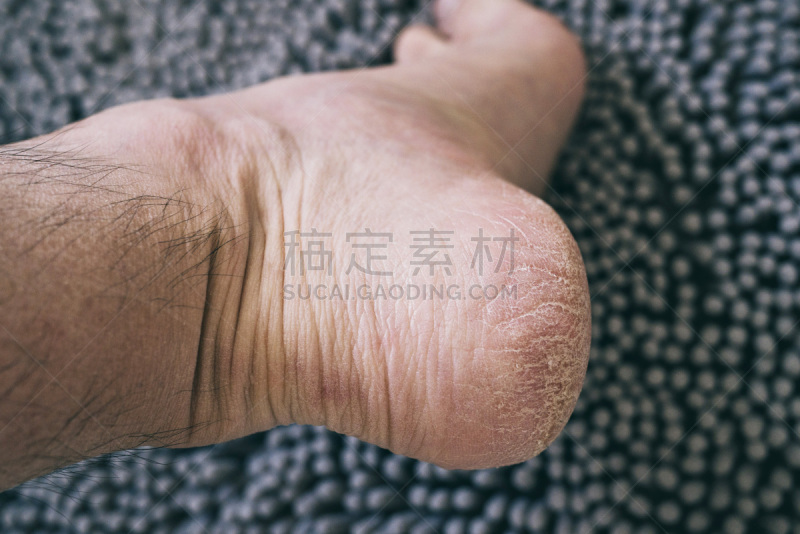 破碎的,足,白色,干的,男性,视角,健康保健,头垢,粗糙的,甲状腺机能减退