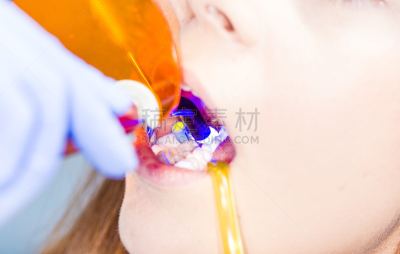 水平画幅,龋齿,人的嘴,牙医,紫外线辐射,青年人,技术,成年的,女人