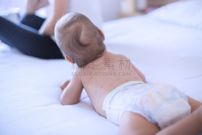 水痘,母亲,婴儿,多次划破,疹,麻疹,尿布,炎症,12到17个月,仅婴儿