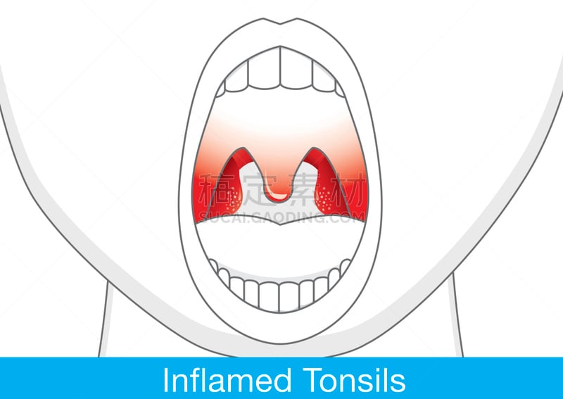 扁桃体,炎症,扁桃腺炎,淋巴结,喉咙痛,声波,肿胀的,喉咙,症状
