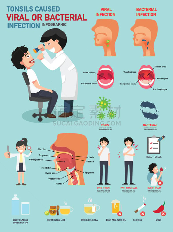 扁桃体,细菌,腭垂,扁桃腺炎,咽炎,喉,肿胀的,喉咙,人类腺体,人的耳朵