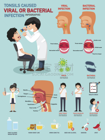 扁桃体,细菌,腭垂,扁桃腺炎,咽炎,喉,肿胀的,喉咙,人类腺体,人的耳朵
