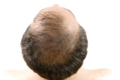 非全秃,发际线后移,不理的,水平画幅,白人,男性,仅男人,仅成年人,头发,人的头部