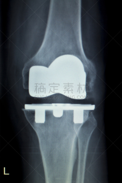金属,钛,x光,隆胸手术,病人,螺丝,膝,现代,整形外科,老年人