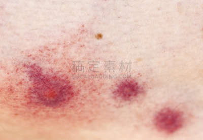 蚊叮咬,过敏反应,认真的,虫咬,水泡,红色,水平画幅,彩色图片,无人