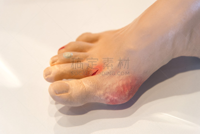 糖尿病,食品,身体受伤,水平画幅,痛苦,人,杜氏肌萎缩症,损坏的,摄影,生病