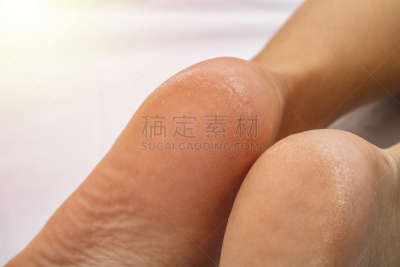 干的,皮肤,足,特写,白色背景,女性,留白,健康保健,部分,皮肤病学