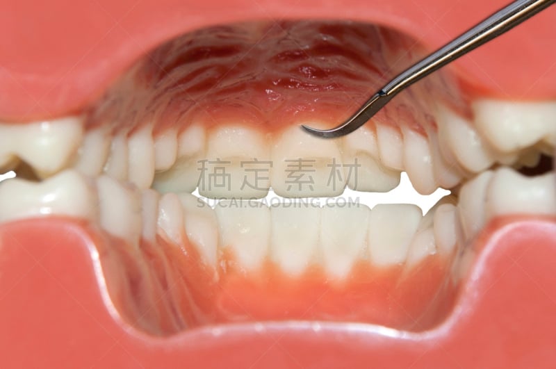 人的嘴,人的牙齿,交通工具内部,闭塞,假牙,牙龈,水平画幅,龋齿,牙医,颌骨