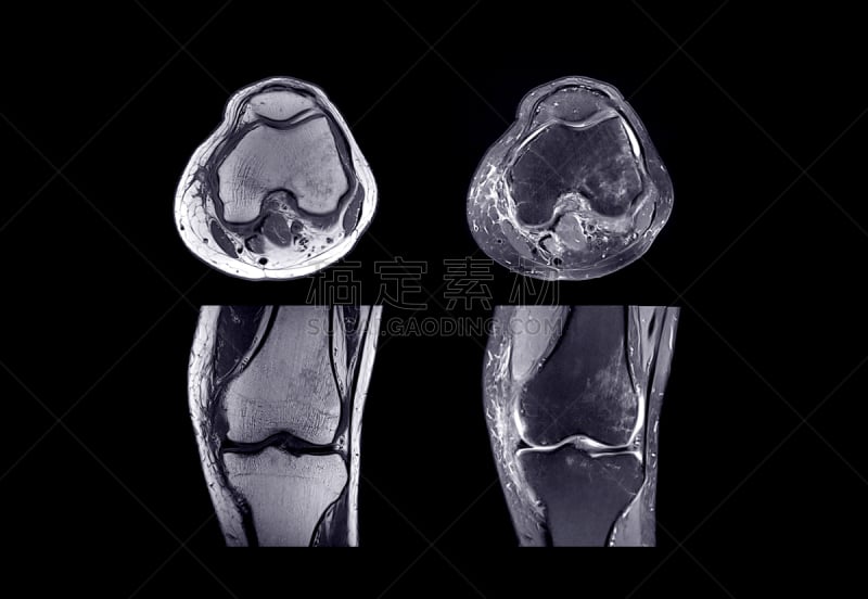 膝,磁共振成象扫描,健康保健,医学检测,运动,药,泰国,技术,腿,人类骨架