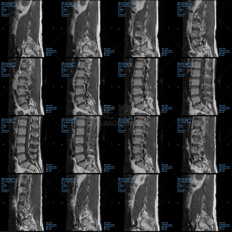 磁共振成象扫描,脊柱,整形器具,柱子,奎宁尾,胸椎,腰椎,尾骨,mri扫描仪,3d扫描