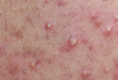 粉刺,皮肤,水平画幅,疤,泰国,细菌,痛苦,皮脂腺,人的脸部