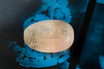 x光片,巨大的,胆石,石头,公亩,胆囊,水平画幅,无人,健康保健