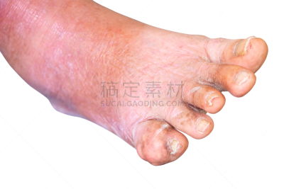 老年人,足,人,白色背景,特写,小指,痛风,成年的,拇指