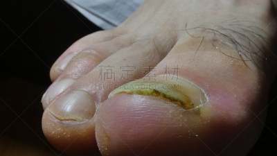 钉子,腿,痛苦,甲真菌病,寒冷,健康保健,部分,药,鞋子,女人