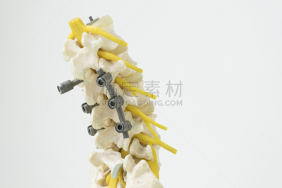 脊柱,设备用品,模型,人造的,水平画幅,无人,金属,神经外科,泰国,疝