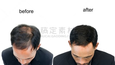 修改系列,秃头,美,水平画幅,美人,古老的,泰国,仅男人,仅成年人,移植手术