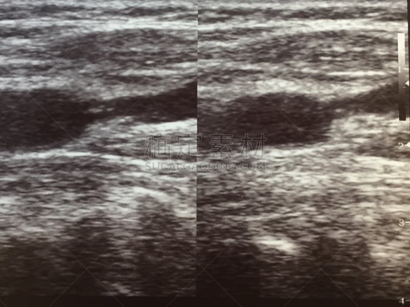 动脉硬化症,颈动脉,鹭管鱼,人,心血管运动,超声波,健康保健,胆固醇测试,心肺系统,声谱仪