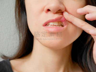 顶部,女人,嘴唇,身体受伤,水平画幅,人的嘴,特写,青年人,肿胀的,白色