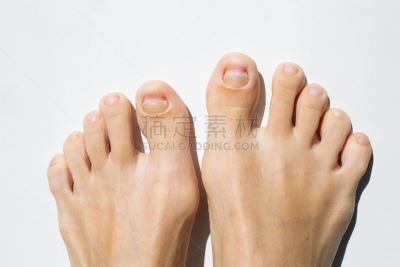 肠道病毒,人体,拇指,损坏的,图像特效,新的,畸形,水平画幅,指甲,巨大的