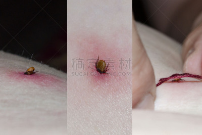 皮肤,动物头,蜱,水平画幅,动物身体部位,蜘蛛纲,夏天,俄罗斯,危险,昆虫