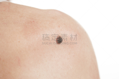 皮肤癌,皮肤,疤,真皮层,仅男人,仅成年人,检查,耐性,后背,基皮细胞癌