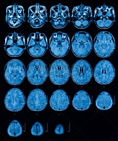 磁共振成象扫描,脑,垂直画幅,神经系统,科学,图像,科学成像技术,人的脸部,技术