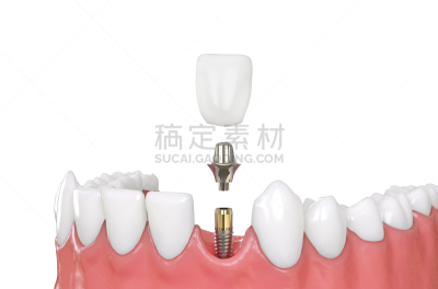 隆胸手术,人的嘴,人的牙齿,模型,牙冠,假牙,假肢,水平画幅,根部,绘画插图
