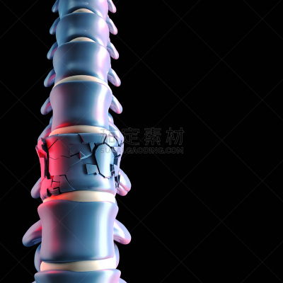 骨骼,三维图形,整形器具,人,骨细胞,腰椎,椎间盘突出,椎间盘,磁盘