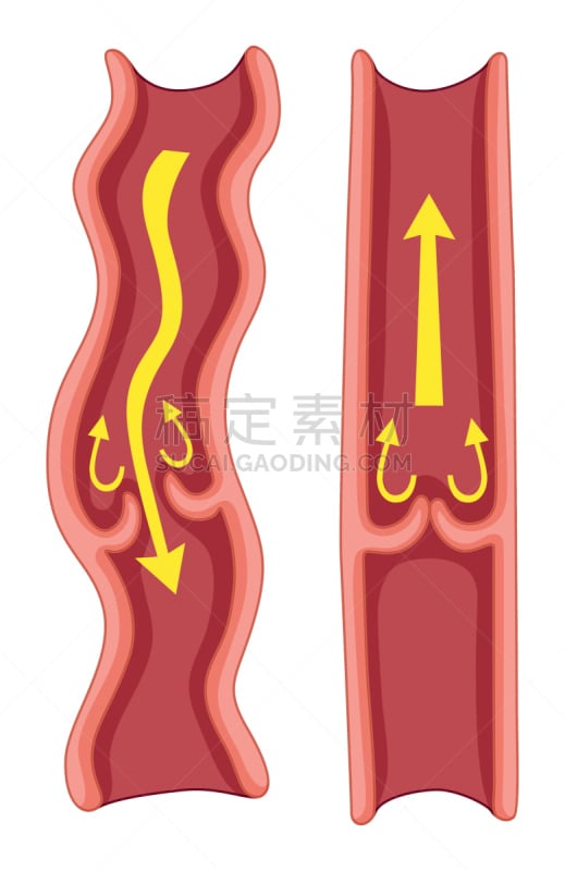 静脉曲张,有序,绘画插图,剪贴画,人,科学,计算机制图,计算机图形学,生物学