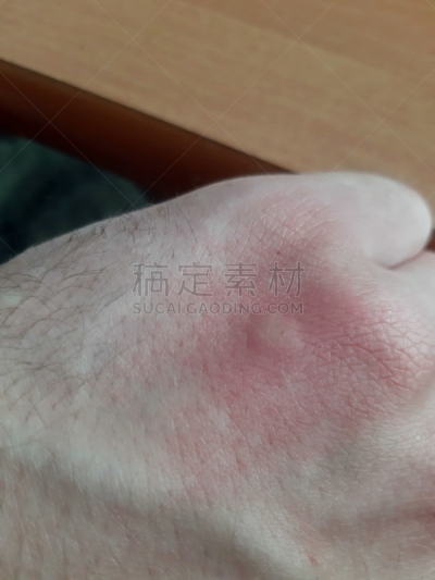 皮肤,蚊子,修改系列,脉搏图,成年的,颈,手指,手,四肢