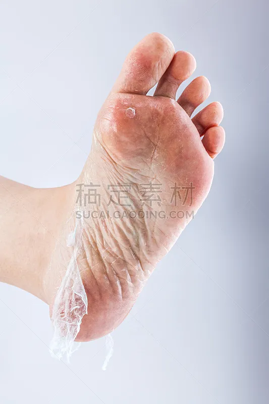 足 破碎的 女人 脚掌 脚病医生 蜈蚣 鞋底 皮肤病学 垂直画幅 美图片素材下载 稿定素材