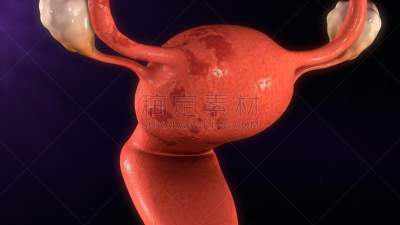 子宫内膜异位,水平画幅,绘画插图,科学,生殖器官,卵巢,成年的,子宫内膜