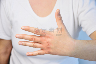 手,t恤,衰老过程,健康,真皮层,干的,仅成年人,皮炎,白色