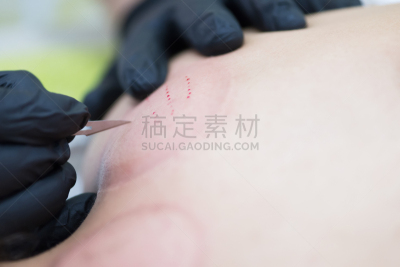 多次划破,动作,附着的,拔罐,药,疤,远古的,传统,图像