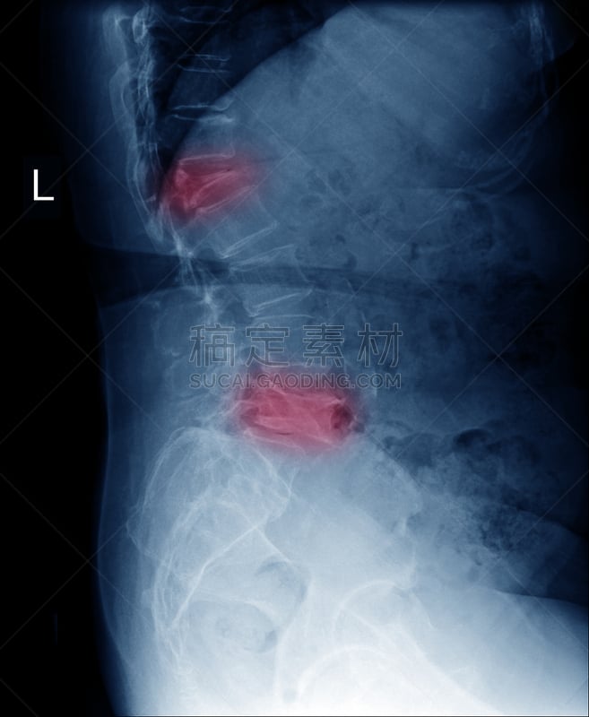 动物脊骨,x光片,居住区,侧面视角,脊柱侧凸,红色,压力,疤,出示