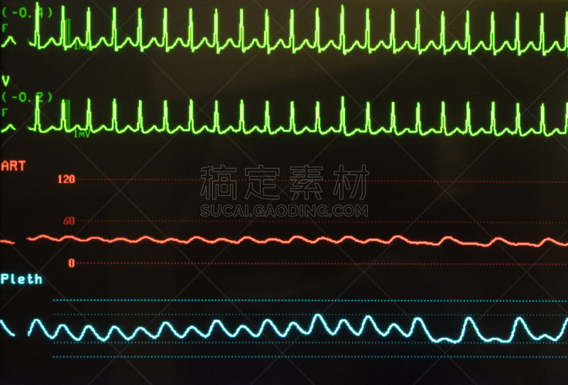 心动过速,黑色,投影屏幕,显示器,健康保健,脉搏图,红色,药,医疗器械,图像