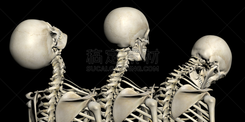 颈部挥鞭样损伤,脖子,生理学,身体受伤,图像特效,颈椎,形态学,3d扫描,脊椎
